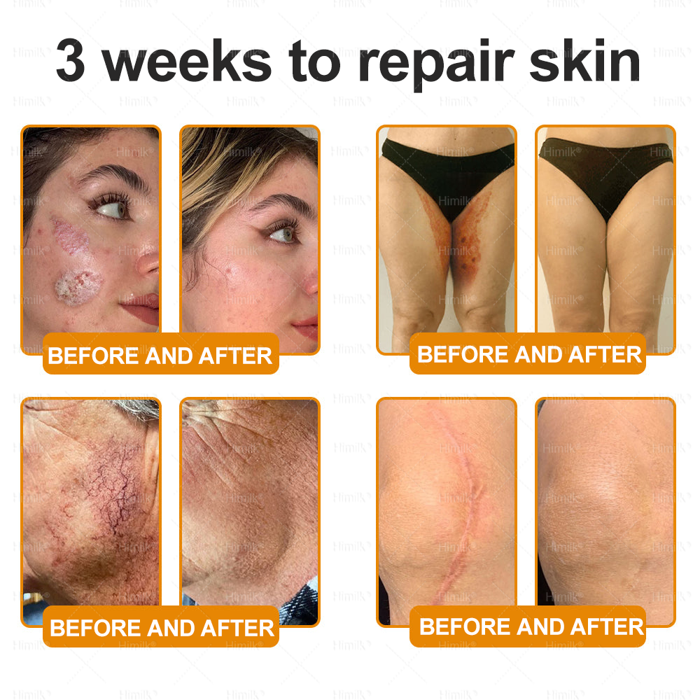 𝑯𝒊𝙢𝒊𝙡𝙠® 𝑩𝐞𝐞 𝑽𝙚𝙣𝙤𝙢 & 𝑻𝙖𝙡𝙡𝙤𝙬 𝑺𝐤𝐢𝐧 𝙍𝐞𝐬𝐭𝐨𝐫𝐚𝐭𝐢𝐨𝐧 𝘾𝐫𝐞𝐚𝐦 –🌸 𝖠𝗇𝗍𝗂-𝖺𝗀𝗂𝗇𝗀,𝖧𝗒𝖽𝗋𝖺𝗍𝗂𝗇𝗀, 𝖲𝗄𝗂𝗇 𝖱𝖾𝗉𝖺𝗂𝗋, 𝖤𝗏𝖾𝗇 𝖳𝗈𝗇𝖾, 𝖠𝖼𝗇𝖾 𝖺𝗇𝖽 𝖣𝖺𝗋𝗄 𝖲𝗉𝗈𝗍 𝖳𝗋𝖾𝖺𝗍𝗆𝖾𝗇𝗍, 𝖶𝖺𝗋𝗍 𝖺𝗇𝖽 𝖬𝗈𝗅𝖾 𝖱𝖾𝗆𝗈𝗏𝖺𝗅, 𝖯𝗌𝗈𝗋𝗂𝖺𝗌𝗂𝗌 𝖱𝖾𝗅𝗂𝖾𝖿