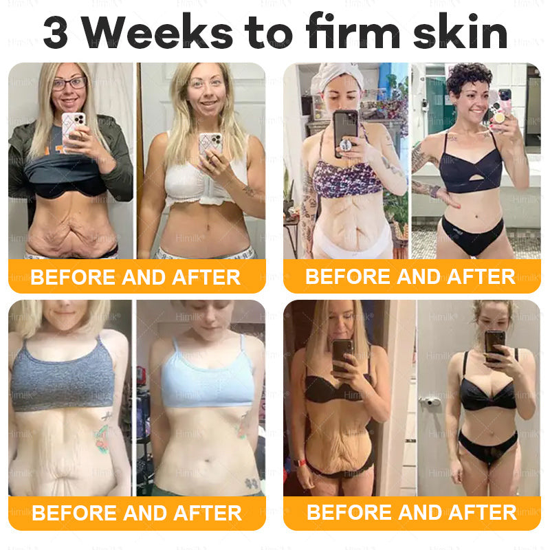 𝑯𝒊𝙢𝒊𝙡𝙠® 𝑩𝐞𝐞 𝑽𝙚𝙣𝙤𝙢 & 𝑻𝙖𝙡𝙡𝙤𝙬 𝑺𝐤𝐢𝐧 𝙍𝐞𝐬𝐭𝐨𝐫𝐚𝐭𝐢𝐨𝐧 𝘾𝐫𝐞𝐚𝐦 –🌸 𝖠𝗇𝗍𝗂-𝖺𝗀𝗂𝗇𝗀,𝖧𝗒𝖽𝗋𝖺𝗍𝗂𝗇𝗀, 𝖲𝗄𝗂𝗇 𝖱𝖾𝗉𝖺𝗂𝗋, 𝖤𝗏𝖾𝗇 𝖳𝗈𝗇𝖾, 𝖠𝖼𝗇𝖾 𝖺𝗇𝖽 𝖣𝖺𝗋𝗄 𝖲𝗉𝗈𝗍 𝖳𝗋𝖾𝖺𝗍𝗆𝖾𝗇𝗍, 𝖶𝖺𝗋𝗍 𝖺𝗇𝖽 𝖬𝗈𝗅𝖾 𝖱𝖾𝗆𝗈𝗏𝖺𝗅, 𝖯𝗌𝗈𝗋𝗂𝖺𝗌𝗂𝗌 𝖱𝖾𝗅𝗂𝖾𝖿