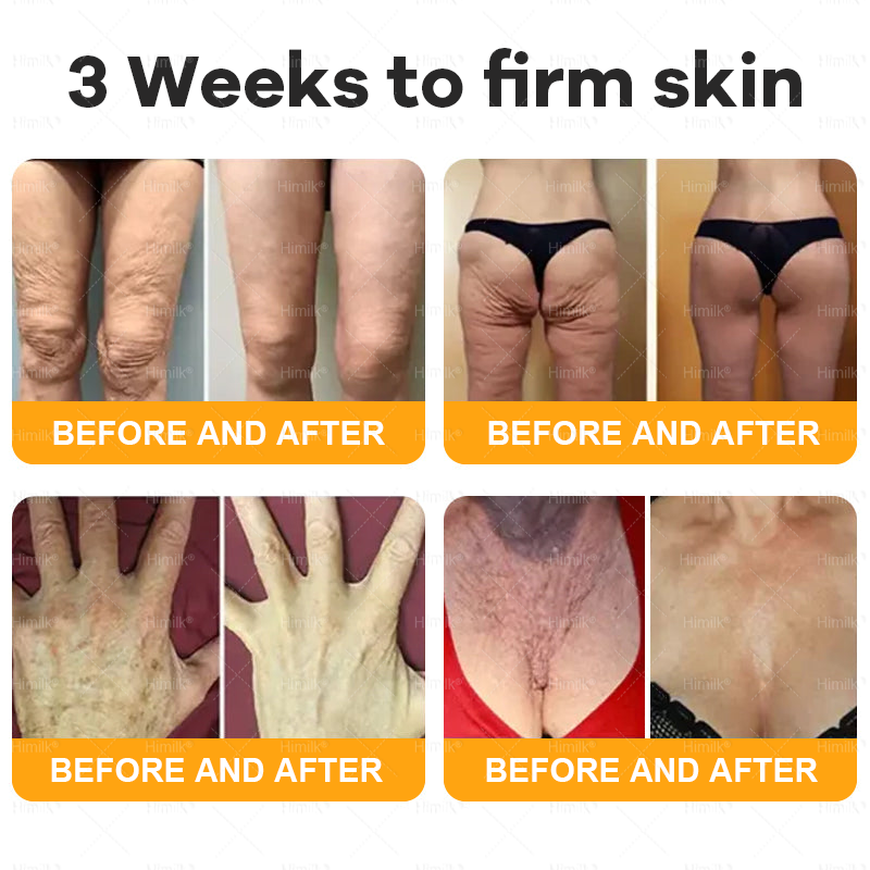 𝑯𝒊𝙢𝒊𝙡𝙠® 𝑩𝐞𝐞 𝑽𝙚𝙣𝙤𝙢 & 𝑻𝙖𝙡𝙡𝙤𝙬 𝑺𝐤𝐢𝐧 𝙍𝐞𝐬𝐭𝐨𝐫𝐚𝐭𝐢𝐨𝐧 𝘾𝐫𝐞𝐚𝐦 –🌸 𝖠𝗇𝗍𝗂-𝖺𝗀𝗂𝗇𝗀,𝖧𝗒𝖽𝗋𝖺𝗍𝗂𝗇𝗀, 𝖲𝗄𝗂𝗇 𝖱𝖾𝗉𝖺𝗂𝗋, 𝖤𝗏𝖾𝗇 𝖳𝗈𝗇𝖾, 𝖠𝖼𝗇𝖾 𝖺𝗇𝖽 𝖣𝖺𝗋𝗄 𝖲𝗉𝗈𝗍 𝖳𝗋𝖾𝖺𝗍𝗆𝖾𝗇𝗍, 𝖶𝖺𝗋𝗍 𝖺𝗇𝖽 𝖬𝗈𝗅𝖾 𝖱𝖾𝗆𝗈𝗏𝖺𝗅, 𝖯𝗌𝗈𝗋𝗂𝖺𝗌𝗂𝗌 𝖱𝖾𝗅𝗂𝖾𝖿