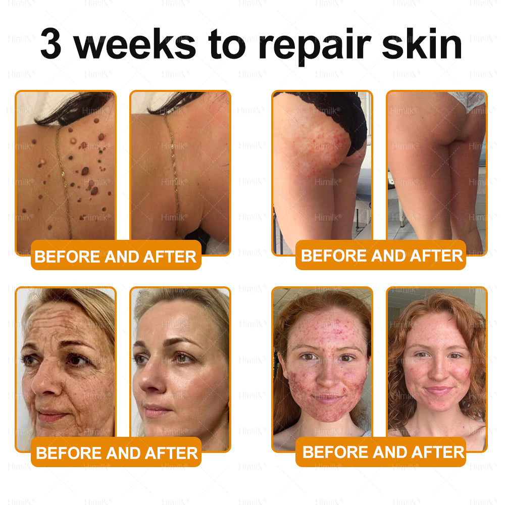 𝑯𝒊𝙢𝒊𝙡𝙠® 𝑩𝐞𝐞 𝑽𝙚𝙣𝙤𝙢 & 𝑻𝙖𝙡𝙡𝙤𝙬 𝑺𝐤𝐢𝐧 𝙍𝐞𝐬𝐭𝐨𝐫𝐚𝐭𝐢𝐨𝐧 𝘾𝐫𝐞𝐚𝐦 –🌸 𝖠𝗇𝗍𝗂-𝖺𝗀𝗂𝗇𝗀,𝖧𝗒𝖽𝗋𝖺𝗍𝗂𝗇𝗀, 𝖲𝗄𝗂𝗇 𝖱𝖾𝗉𝖺𝗂𝗋, 𝖤𝗏𝖾𝗇 𝖳𝗈𝗇𝖾, 𝖠𝖼𝗇𝖾 𝖺𝗇𝖽 𝖣𝖺𝗋𝗄 𝖲𝗉𝗈𝗍 𝖳𝗋𝖾𝖺𝗍𝗆𝖾𝗇𝗍, 𝖶𝖺𝗋𝗍 𝖺𝗇𝖽 𝖬𝗈𝗅𝖾 𝖱𝖾𝗆𝗈𝗏𝖺𝗅, 𝖯𝗌𝗈𝗋𝗂𝖺𝗌𝗂𝗌 𝖱𝖾𝗅𝗂𝖾𝖿