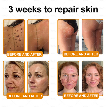 𝑯𝒊𝙢𝒊𝙡𝙠® 𝑩𝐞𝐞 𝑽𝙚𝙣𝙤𝙢 & 𝑻𝙖𝙡𝙡𝙤𝙬 𝑺𝐤𝐢𝐧 𝙍𝐞𝐬𝐭𝐨𝐫𝐚𝐭𝐢𝐨𝐧 𝘾𝐫𝐞𝐚𝐦 –🌸 𝖠𝗇𝗍𝗂-𝖺𝗀𝗂𝗇𝗀,𝖧𝗒𝖽𝗋𝖺𝗍𝗂𝗇𝗀, 𝖲𝗄𝗂𝗇 𝖱𝖾𝗉𝖺𝗂𝗋, 𝖤𝗏𝖾𝗇 𝖳𝗈𝗇𝖾, 𝖠𝖼𝗇𝖾 𝖺𝗇𝖽 𝖣𝖺𝗋𝗄 𝖲𝗉𝗈𝗍 𝖳𝗋𝖾𝖺𝗍𝗆𝖾𝗇𝗍, 𝖶𝖺𝗋𝗍 𝖺𝗇𝖽 𝖬𝗈𝗅𝖾 𝖱𝖾𝗆𝗈𝗏𝖺𝗅, 𝖯𝗌𝗈𝗋𝗂𝖺𝗌𝗂𝗌 𝖱𝖾𝗅𝗂𝖾𝖿